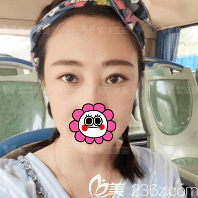 張金娥醫(yī)生給我做UM無(wú)痕不開(kāi)刀祛眼袋第11天效果 張金娥醫(yī)生給我做UM無(wú)痕不開(kāi)刀祛眼袋第11天效果