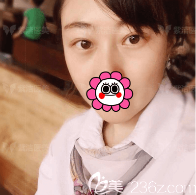 在北京紫潔醫(yī)美做無(wú)痕不開(kāi)刀祛眼袋第32天效果 在北京紫潔醫(yī)美做無(wú)痕不開(kāi)刀祛眼袋第32天效果