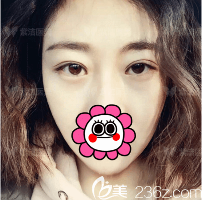 北京紫潔醫(yī)美UM無(wú)痕不開(kāi)刀祛眼袋案例 北京紫潔醫(yī)美UM無(wú)痕不開(kāi)刀祛眼袋案例