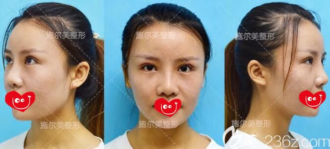 到常州施爾美做眼鼻脂肪豐額頭1月恢復(fù)