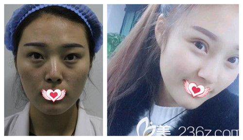 邯鄲京美4月推出大量整形優(yōu)惠活動(dòng) 888元就能擁有自然無(wú)痕雙眼皮