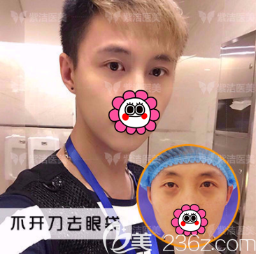 北京紫潔儷方不開刀祛眼袋案例