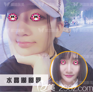 北京紫潔醫(yī)美注射豐唇案例