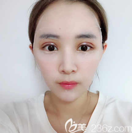 雙眼皮術(shù)后四天消腫情況