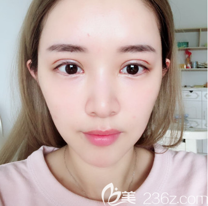 全切雙眼皮術(shù)后八天恢復(fù)效果圖