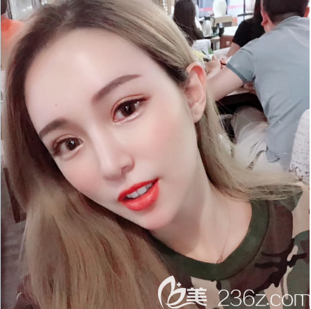 深圳美萊割雙眼皮術(shù)后一個月效果圖