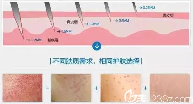 無錫施爾美分享微針美膚原理
