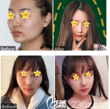 顴骨內(nèi)推手術(shù)案例