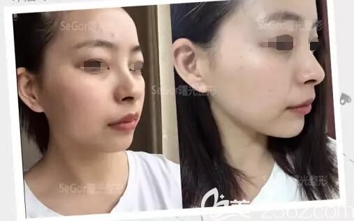 術(shù)后三天玻尿酸豐下巴和術(shù)前對比