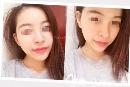 擔(dān)心假體隆下巴創(chuàng)傷大術(shù)后恢復(fù)慢就面診常州曙光醫(yī)生注射玻尿酸豐下巴，2支喬雅登價(jià)格貴但術(shù)后效果自然