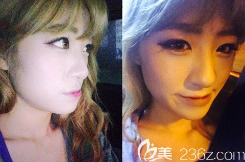 在韓國id雙鄂手術+顴骨縮小術前 在韓國id雙鄂手術+顴骨縮小術前