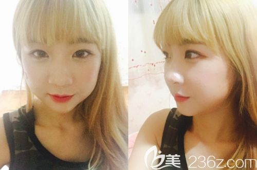 在韓國id雙鄂手術+顴骨縮小術后1個月 在韓國id雙鄂手術+顴骨縮小術后1個月