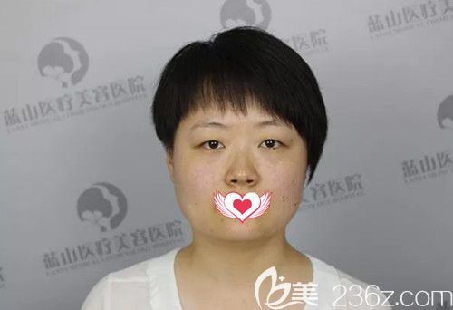 在藍(lán)山整形醫(yī)院做雙眼皮術(shù)前是無(wú)神單眼皮 在藍(lán)山整形醫(yī)院做雙眼皮術(shù)前是無(wú)神單眼皮