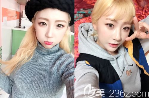 在韓國id雙鄂手術+顴骨縮小術后6個月 在韓國id雙鄂手術+顴骨縮小術后6個月