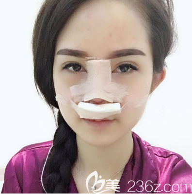 在東莞華美做完鼻子第二天