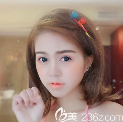 東莞華美鼻綜合隆鼻7天拆線效果圖