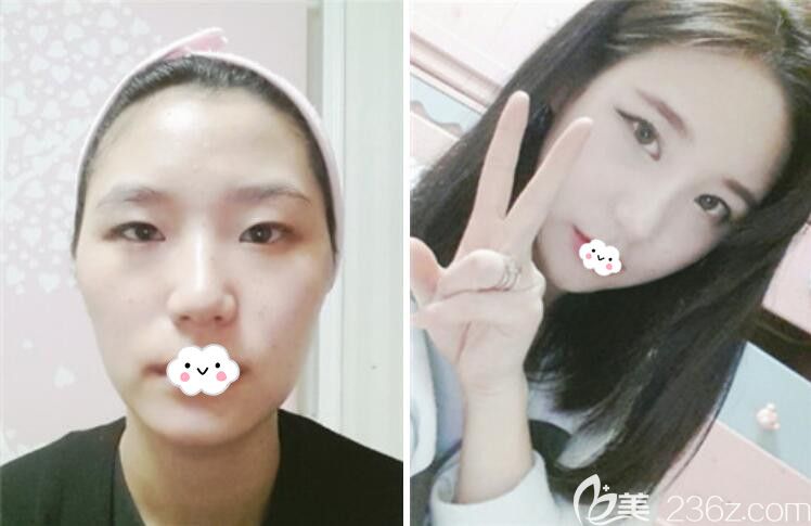 韓國樂得千成俊面部輪廓+韓式無痕雙眼皮+假體隆鼻案例效果對比圖 韓國樂得千成俊面部輪廓+韓式無痕雙眼皮+假體隆鼻案例效果對比圖