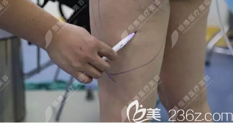 李烈自體脂肪豐臀術(shù)前設(shè)計(jì)