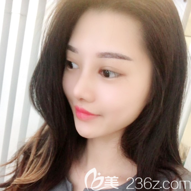 東莞韓美隆鼻術(shù)后半個月自拍照片