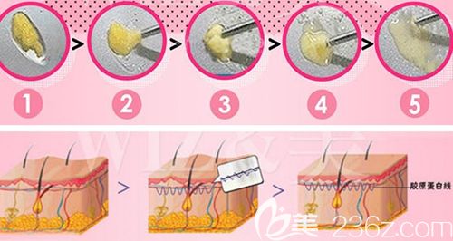 韓國(guó)WIZ&美吸脂手術(shù)過程