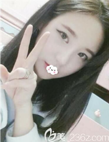 我的赴韓整形攻略,記錄韓國樂得red整形外科做韓式無痕雙眼皮+隆鼻+面部輪廓效果