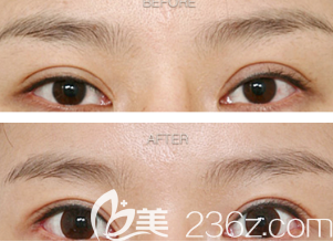 假厚寬雙眼皮修復(fù)案例
