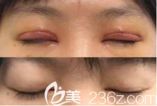 雙眼皮瘢痕修復(fù)案例