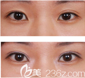 雙眼皮寬窄不一修復(fù)案例