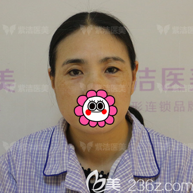 在北京紫潔做隱形懸眉術(shù)前樣子 在北京紫潔做隱形懸眉術(shù)前樣子