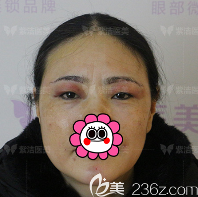 北京紫潔醫(yī)生給我做隱形懸眉術(shù)第2天樣子 北京紫潔醫(yī)生給我做隱形懸眉術(shù)第2天樣子
