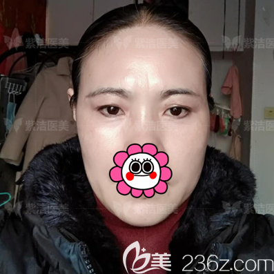 在北京紫潔醫(yī)美做隱形懸眉術(shù)第21天效果 在北京紫潔醫(yī)美做隱形懸眉術(shù)第21天效果