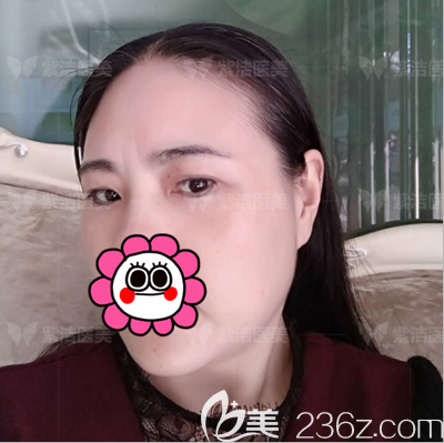 北京紫潔儷方醫(yī)療美容診所隱形懸眉術(shù)案例 北京紫潔儷方醫(yī)療美容診所隱形懸眉術(shù)案例