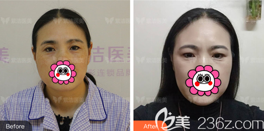 北京紫潔醫(yī)美隱形懸眉術(shù)前后對(duì)比照 北京紫潔醫(yī)美隱形懸眉術(shù)前后對(duì)比照