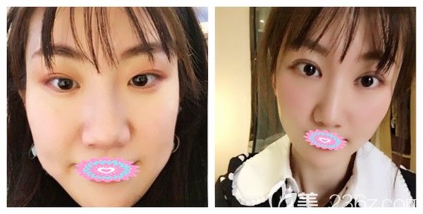 武漢<!--<i data=20240709-sp></i>-->羅曉醫(yī)生雙眼皮失敗修復(fù)，眼綜合+瘦臉術(shù)后對(duì)比照案例