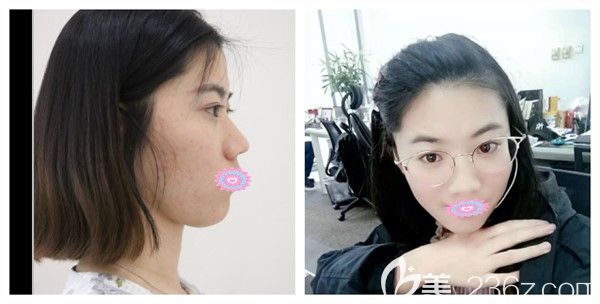 武漢<!--<i data=20240709-sp></i>-->羅曉主任超皮秒激光祛疤案例照展示