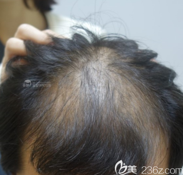 植發(fā)術(shù)前 植發(fā)術(shù)前