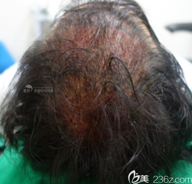 植發(fā)術(shù)后 植發(fā)術(shù)后