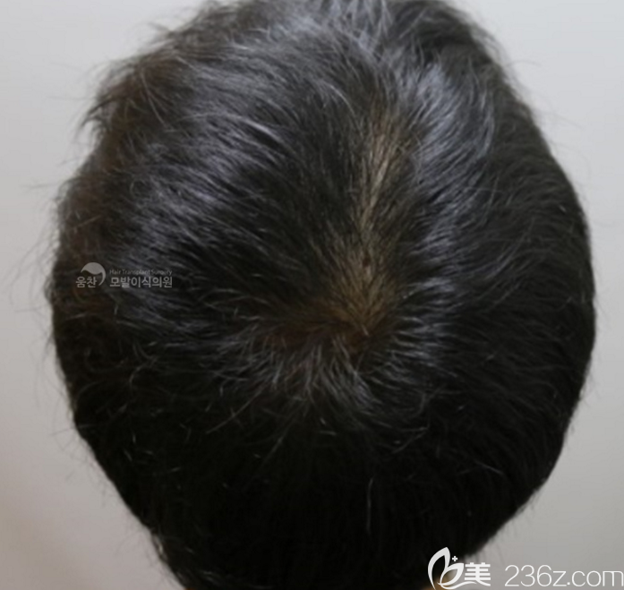 M字禿韓國Woomchan永長玄尚潤切開+非切開植發(fā)6200根直接上圖
