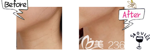 激光去除頸紋案例