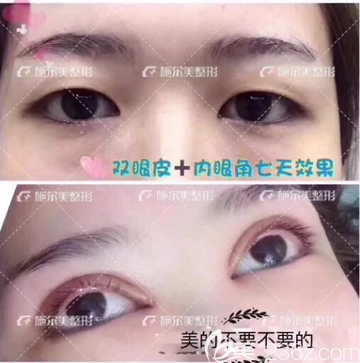 常州施爾美分享兩眼距過寬做雙眼皮+開眼角術(shù)后七天效果
