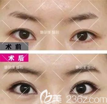 常州施爾美下瞼下至做眼綜合案例效果