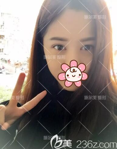 看常州施爾美東方芭比眼案例效果不錯 也去面診做了眼皮+內(nèi)眥開大告別有腫眼泡的內(nèi)雙眼還改善了兩眼間距