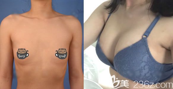 溫州藝星徐淑卿假體隆胸案例 溫州藝星徐淑卿假體隆胸案例