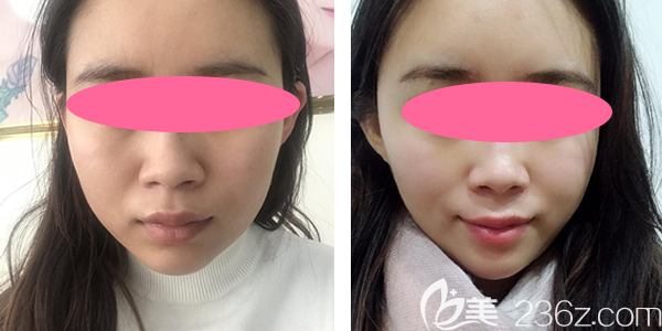 分享我在贛州韓美整形瘦臉一個月前后對比圖