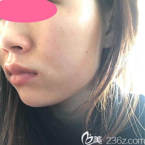 在贛州韓美整形注射瘦臉第5天效果