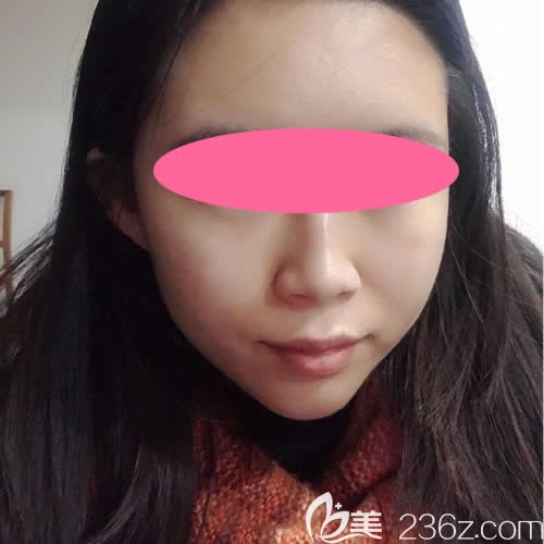 在贛州韓美注射瘦臉術后第10天效果