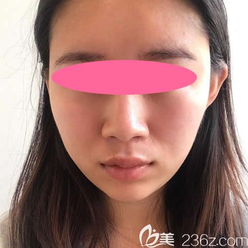 在贛州韓美整形醫(yī)院打瘦臉除皺瘦臉術后第23天效果圖