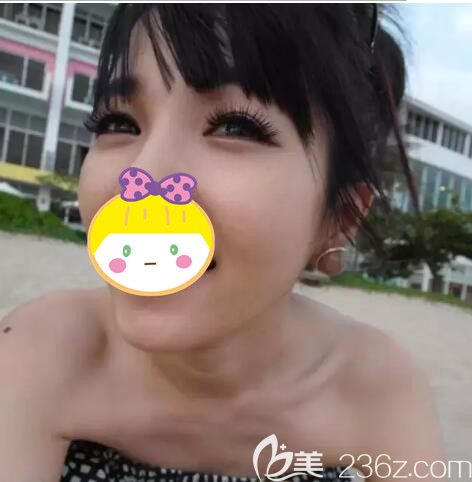 追求笑容甜美的我到無錫坤如瑪麗注射了0.2毫升玻尿酸豐臥蠶 術后沒下垂不擴散還少女感十足