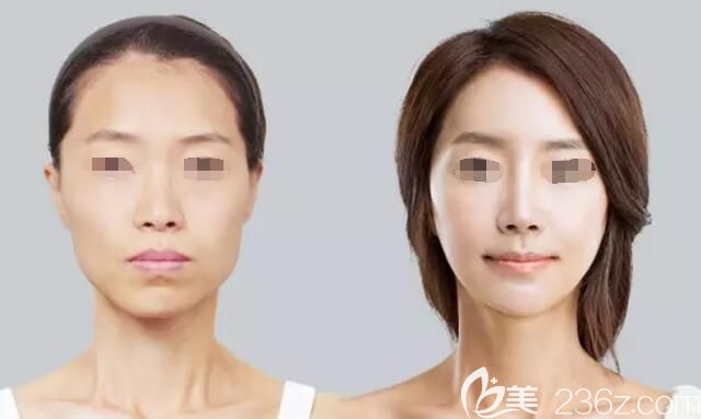 周海峰微整抗衰案例