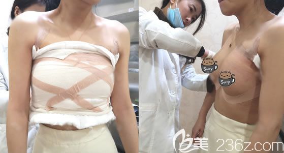 溫州藝星假體隆胸案例拆線過(guò)程 溫州藝星假體隆胸案例拆線過(guò)程